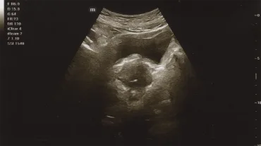 Foto hasil USG (Ultrasonografi) pertama, 15 Agustus 2025.