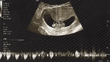 Hasil USG Kedua, Senin 15 September 2025. Saat pertama kali kami mendengar detak jantungmu.